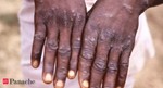 Covid vaccine doesn't cause monkeypox: Busting common myths about this ailment